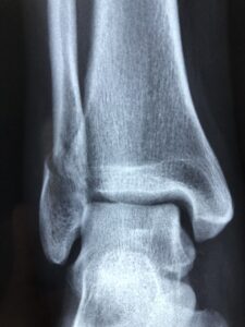 radiography, diagnosis, anatomy, injury, radiology, bone, healthcare, xray, health, medical, disease, ankle, sprain, fracture, blue health, blue medical, blue healthcare, xray, xray, xray, xray, xray, ankle, fracture